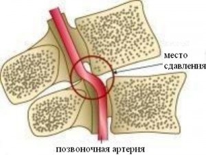 Szédülés a osteochondrosis a nyaki gerinc (tüneti kezelés)