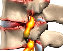 Herniated tipuri de coloanei vertebrale, simptome și tratament