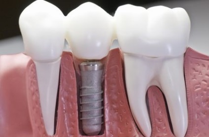 Implantarea dinților