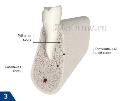 Імпланти roott швейцария - відгуки про рут, фото до і після, ціна 2017