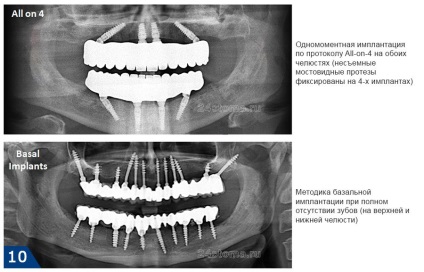 Implants roott elveția - comentarii despre Ruth, fotografii înainte și după, preț 2017