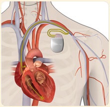 Beültethető kardioverter-defibrillátor (ICD)