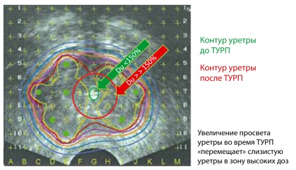 Интерстициална лъчева терапия (брахитерапия) за рак на простатата - 10 години в Русия,