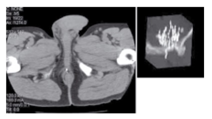 Radioterapia interstițială (brahiterapie) de cancer de prostată - 10 ani în Rusia,