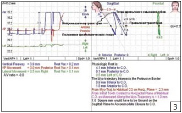 Utilizarea miostimulării cu ultra-joasă frecvență în stomatologia estetică