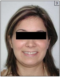 Utilizarea miostimulării cu ultra-joasă frecvență în stomatologia estetică