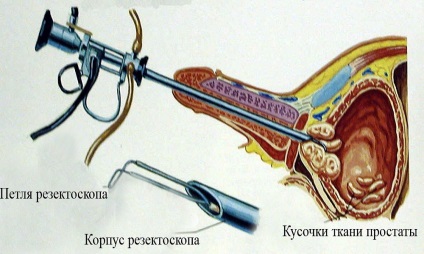 Cum se desfasoara o operatie de indepartare a adenomului prostatic (glanda prostatica)