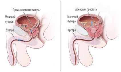 Cum se desfasoara o operatie de indepartare a adenomului prostatic (glanda prostatica)