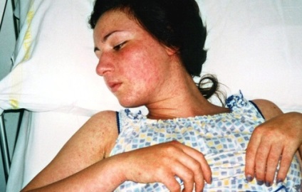 Cum începe varicela la adulți - simptome și fotografii