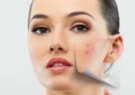 Cum să eliminați pete de acnee - eliminați repede pete roșii după acnee
