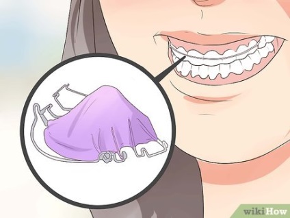 Як доглядати за стоматологічним ретейнер