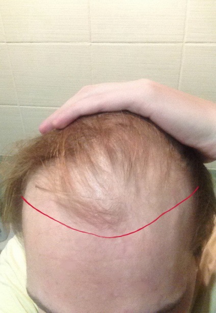 Як я робив пересадку волосся і результат через 3, 5 місяці