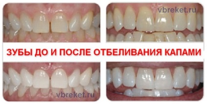 Terapii de albire a dinților - nu ezitați să zâmbiți - despre corecția mușcăturii și brațele