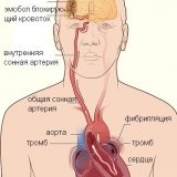 Ce complicații pot provoca aritmie cardiacă - medicul dvs. aibolit