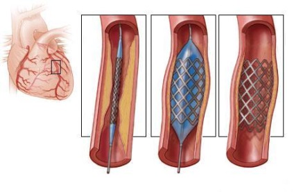 Stentul coronarian - tratamentul inimii