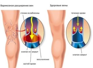 Червоні плями на ногах при варикозі лікування почервоніння з фото сухих новоутворень коричневого