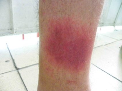 Pete roșii pe picioare cu tratament varicos de roșeață, cu o fotografie a tumorilor uscate de maro