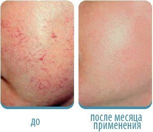 Cream „kéreg” származó rosacea visszajelzést arról, hogy a krém segít, hogy ezt a bőrt hiba