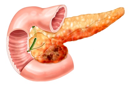 Dohányzás pancreatitis a hasnyálmirigy várni következményei