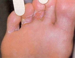 Лікування грибка на ногах народними засобами