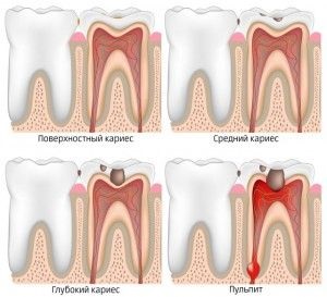 Tratamentul pulpitei tratate, etape, metoda biologică