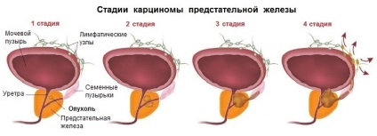 Лікування раку содою на всіх стадіях метастази