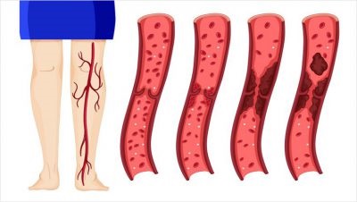 Thrombosis mélyvénás