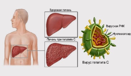 Лечение на вирусен хепатит в Китай терапии, цени