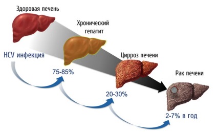 Tratamentul hepatitei virale în metode de terapie din China, prețuri