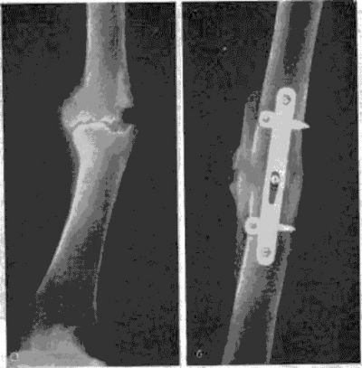 Помилковий суглоб (псевдоартроз) після перелому шийки стегна, ключиці і т