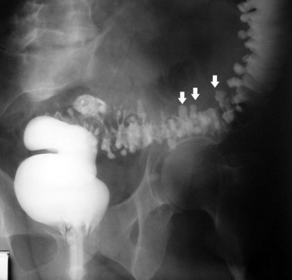 Diagnosticul de radiografie al chisturilor hepatice