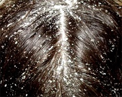 Maszkok és tömöríti sókat alopecia