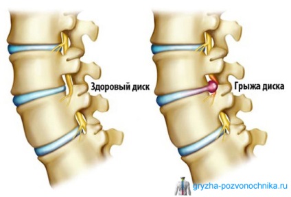 Hernia mediană, cum să tratezi o hernie