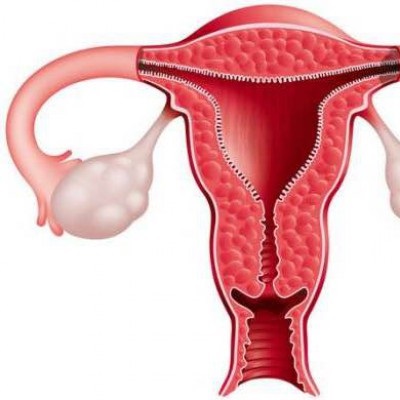 Tulburări și chisturi cauzate de chisturile multiple ale ovarelor