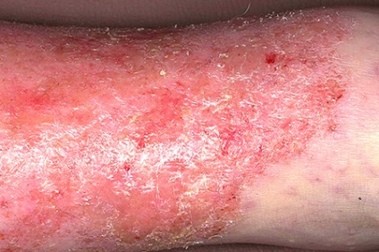 Wetting cauzele eczeme și tratamentul eczemelor umede pe picioare remedii folk