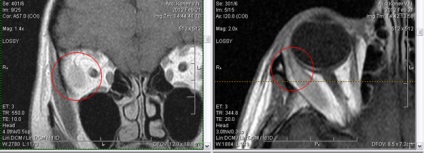 Mrt expert, мрт în diagnosticarea bolilor de orbite