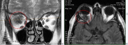 Mrt expert, мрт în diagnosticarea bolilor de orbite