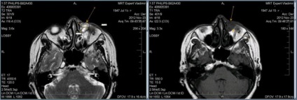 Mrt expert, мрт în diagnosticarea bolilor de orbite