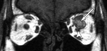 Mrt expert, мрт în diagnosticarea bolilor de orbite