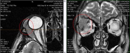 Mrt expert, мрт în diagnosticarea bolilor de orbite