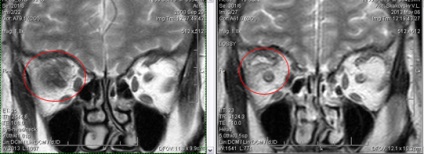 Mrt expert, мрт în diagnosticarea bolilor de orbite