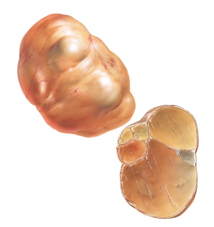 Mucinosus cystadenoma (petefészek ciszta) mucinosus cystadenoma