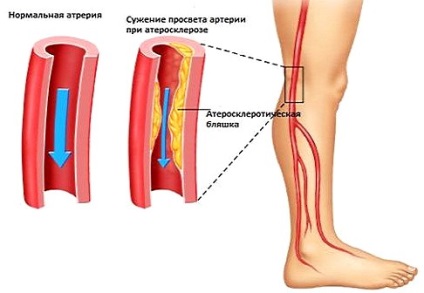 Німіє нога від стегна до стопи