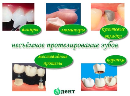 Незнімне протезування зубів види, догляд, переваги і недоліки протезування