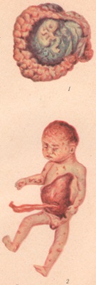 Nașteri nereușite; macerarea, mumificarea și calcificarea fetusului - site-ul medical