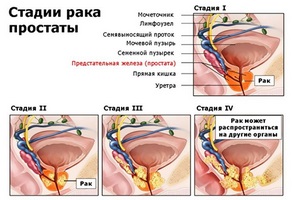 Așa cum reiese din incluziunile hiperechoice din glanda prostatică