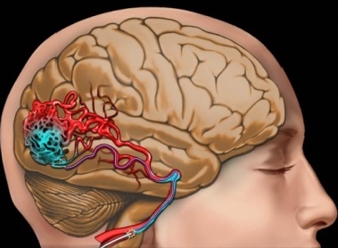 Purificarea vaselor cerebrale, retete, remedii populare