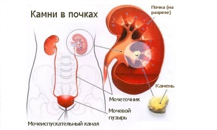 Oxalat pietre la rinichi cum să scape de oxalați