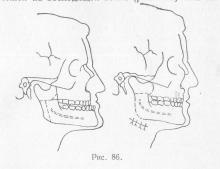 Chirurgie pentru ocluzie mesială, stomatologie ortopedică