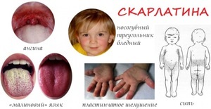 Jellemzői kezelés skarlát a gyermek tünetei, formái, kezelése